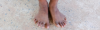 Polydactylie-fi.png